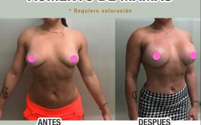 Aumento de mamas, de $2,700 dólares en adelante.