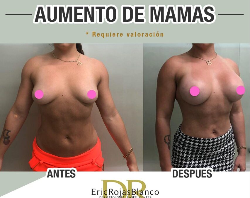 Aumento de mamas, de $2,700 dólares en adelante.