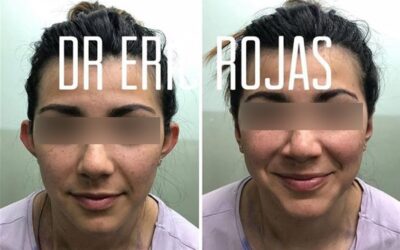 Dermo Otoplastía  en un increíble precio, por solo $950 USD.