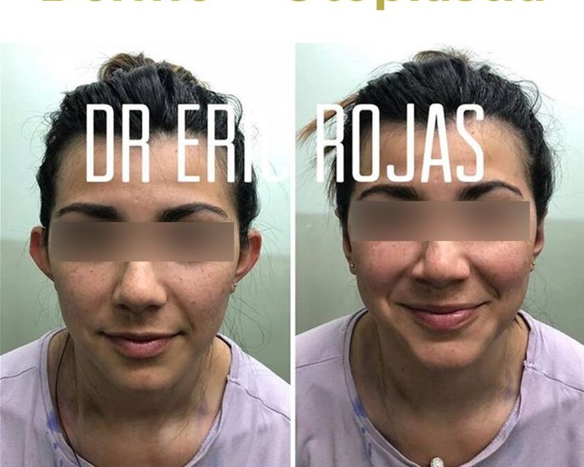 Dermo Otoplastía  en un increíble precio, por solo $950 USD.
