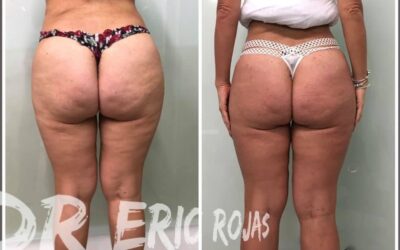 Contamos con la mejor herramienta para eliminar la celulitis.