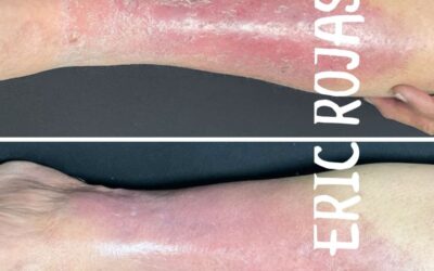 CELULITIS DE PIEL DR ERIC ROJAS