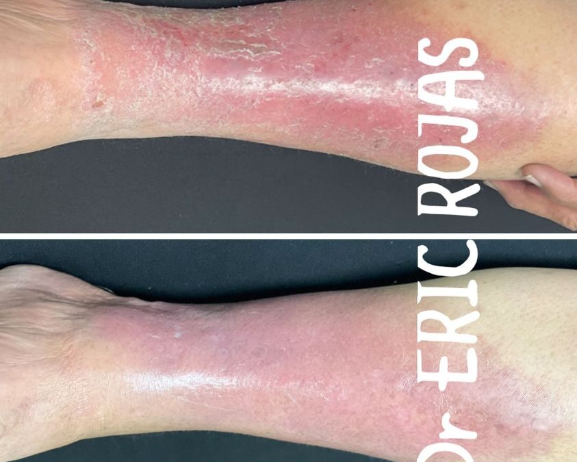 CELULITIS DE PIEL DR ERIC ROJAS