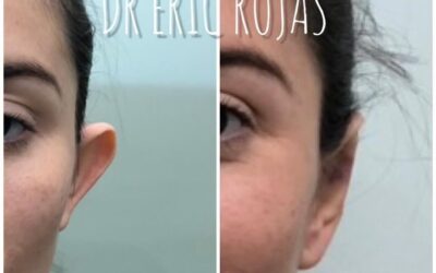 Corrección de orejas, ¡En 20 minutos!