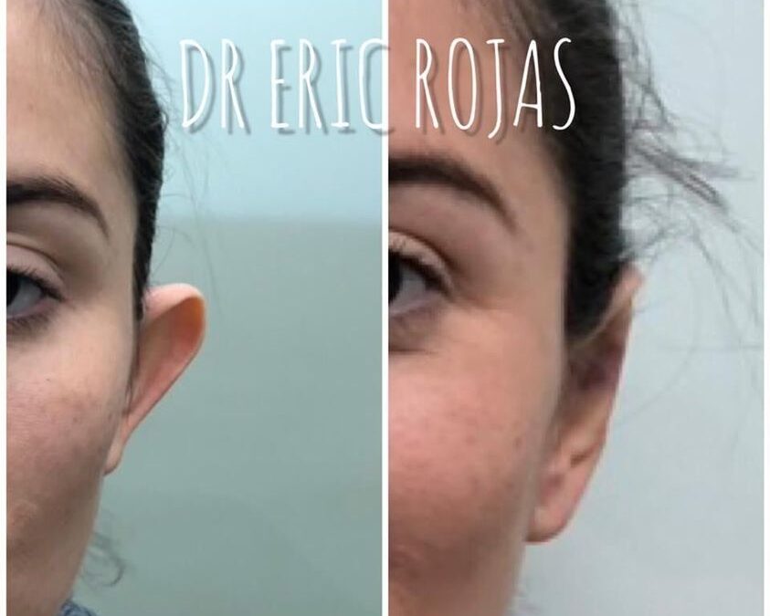 Corrección de orejas, ¡En 20 minutos!