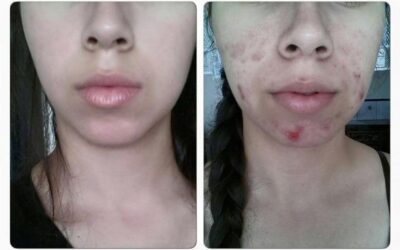 Limpia tu rostro, con el mejor tratamiento del país.