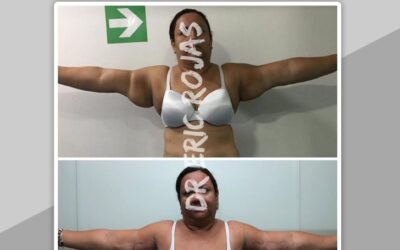 Slim láser en Brazos, ven a tu consulta de valoración.