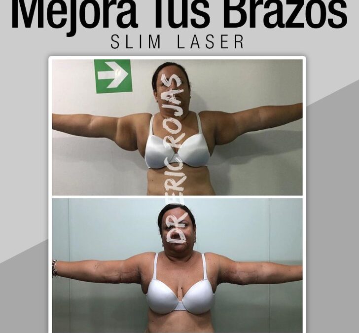 Slim láser en Brazos, ven a tu consulta de valoración.