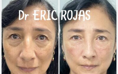 Rejuvenece tu rostro y reduce tus ojeras.