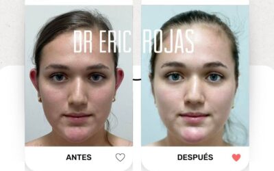 Dermo Otoplastía en tan solo $950 dólares, la mejor técnica para corregir tus orejas está a tu alcance con nosotros.