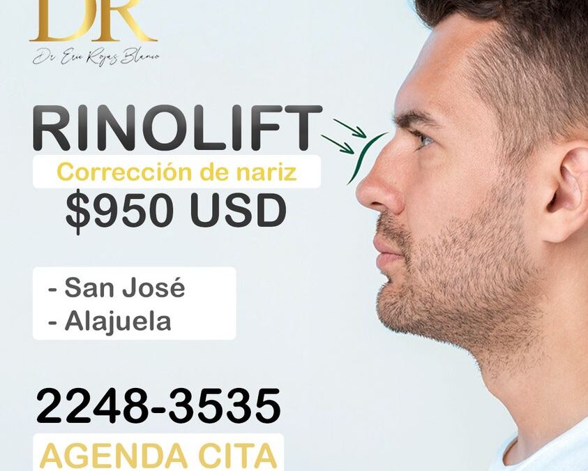 Rinolift es la mejor técnica para corregir tu nariz.