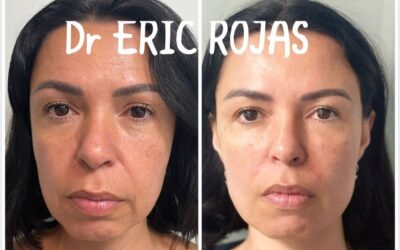 Rejuvenece tu rostro, somos los mejores para tu procedimiento.