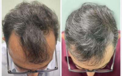 Elimina la alopecia de tu cabeza, nosotros tenemos la solución.