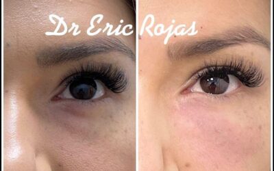 Adiós Ojeras, las mejores técnicas.