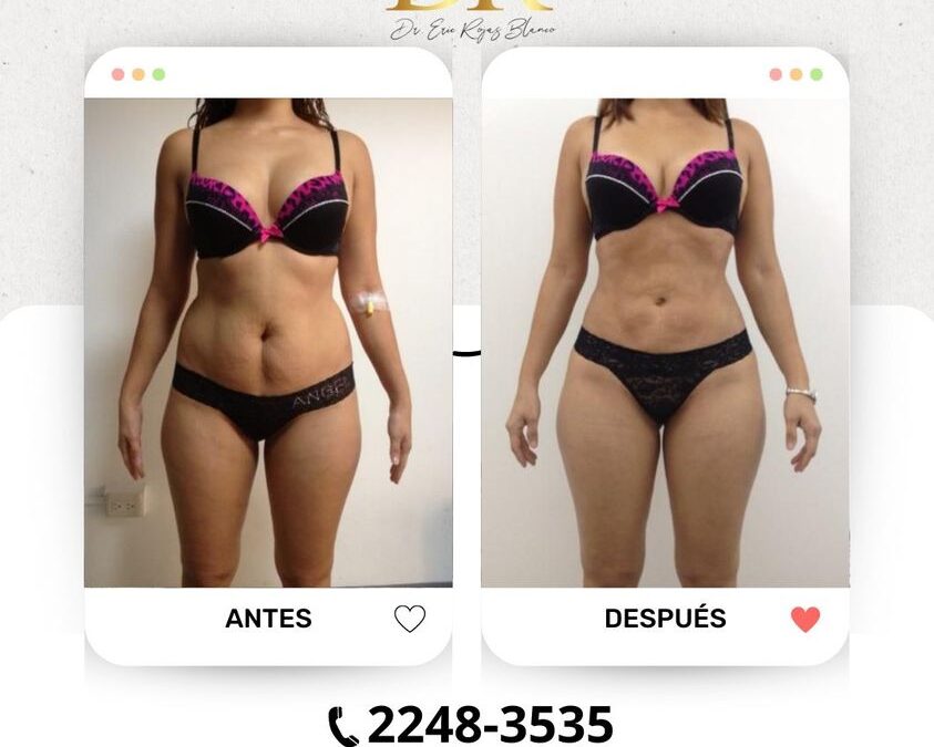 La mejor técnica del país a tu alcance, es Slim Láser.