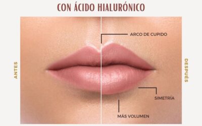 Increíble aumento de labios para el mes de mamá, no esperes más.