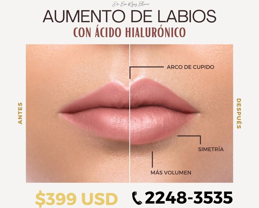 Increíble aumento de labios para el mes de mamá, no esperes más.