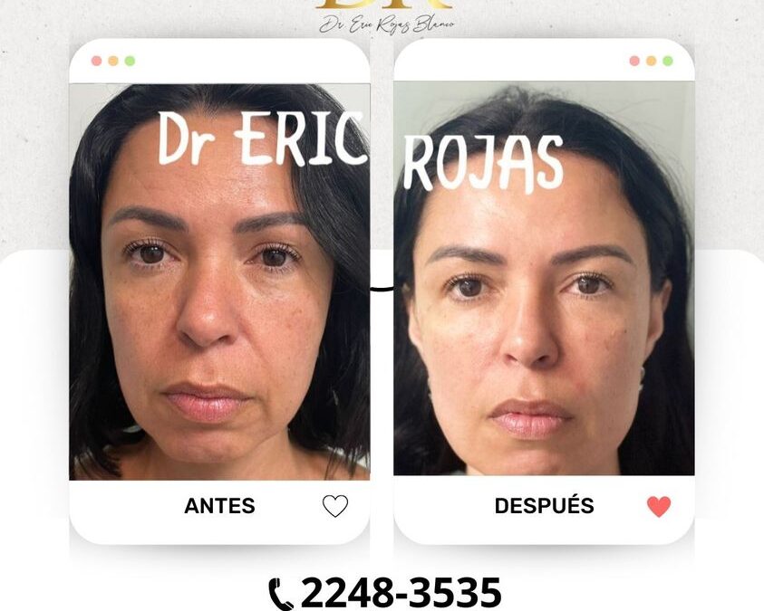 Rejuvenece tu rostro con las últimas técnicas.