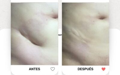 ¿Sabes que somos expertos eliminando cicatrices?