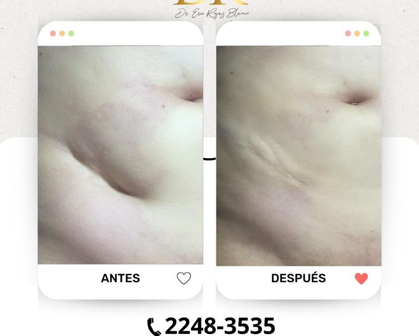 ¿Sabes que somos expertos eliminando cicatrices?