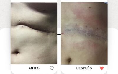 Mejoría de cicatriz en abdomen.