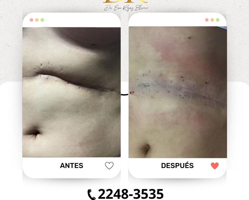 Mejoría de cicatriz en abdomen.