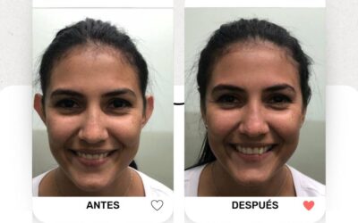 La dermo Otoplastía es la mejor técnica