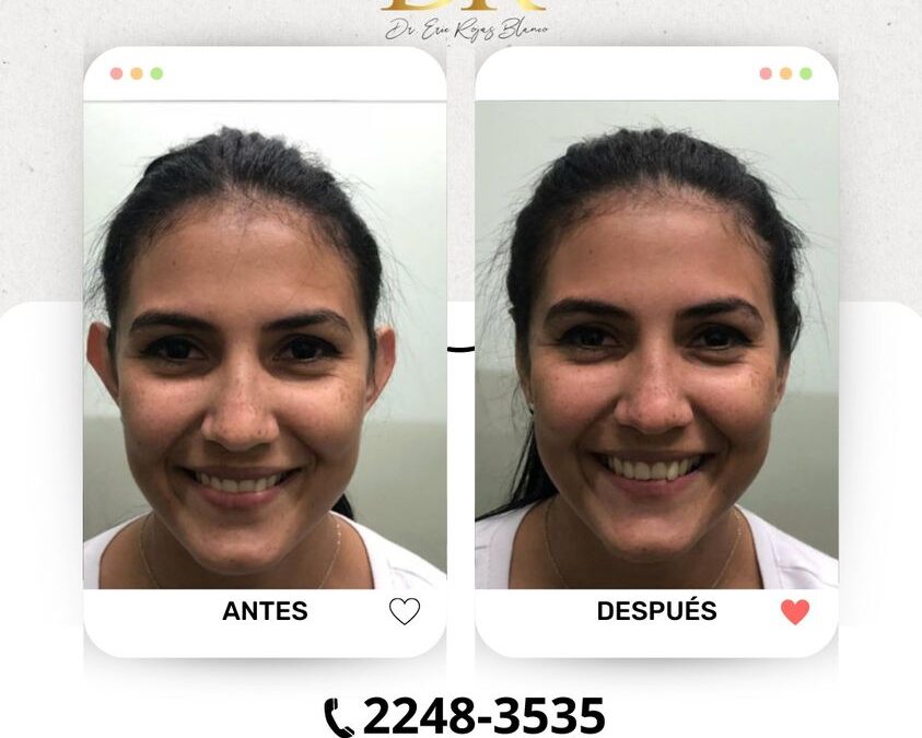 La dermo Otoplastía es la mejor técnica