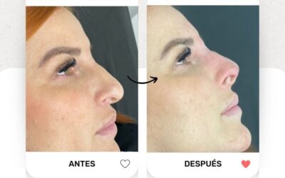 Rinolift por solo $950 dólares, la mejor oportunidad a tu alcance.