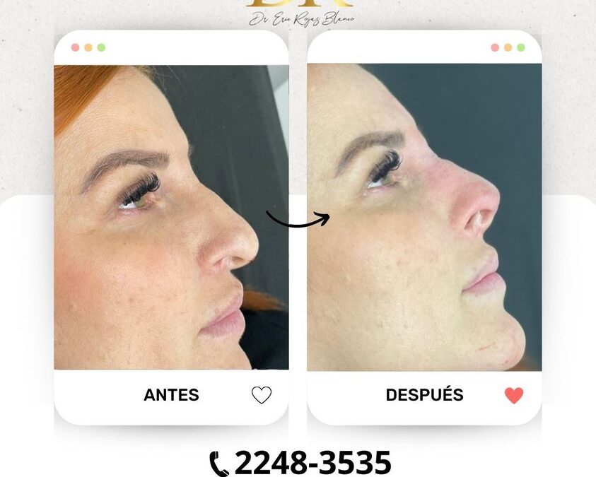 Rinolift por solo $950 dólares, la mejor oportunidad a tu alcance.