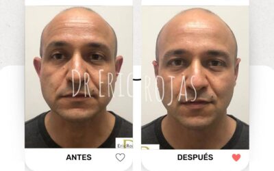 Dermo Otoplastía, corrección de orejas.