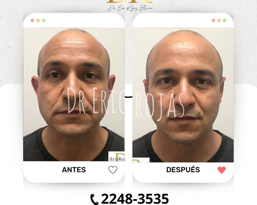 Dermo Otoplastía, corrección de orejas.
