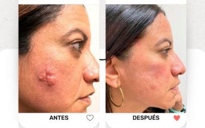 Eliminamos este Cáncer de Piel.