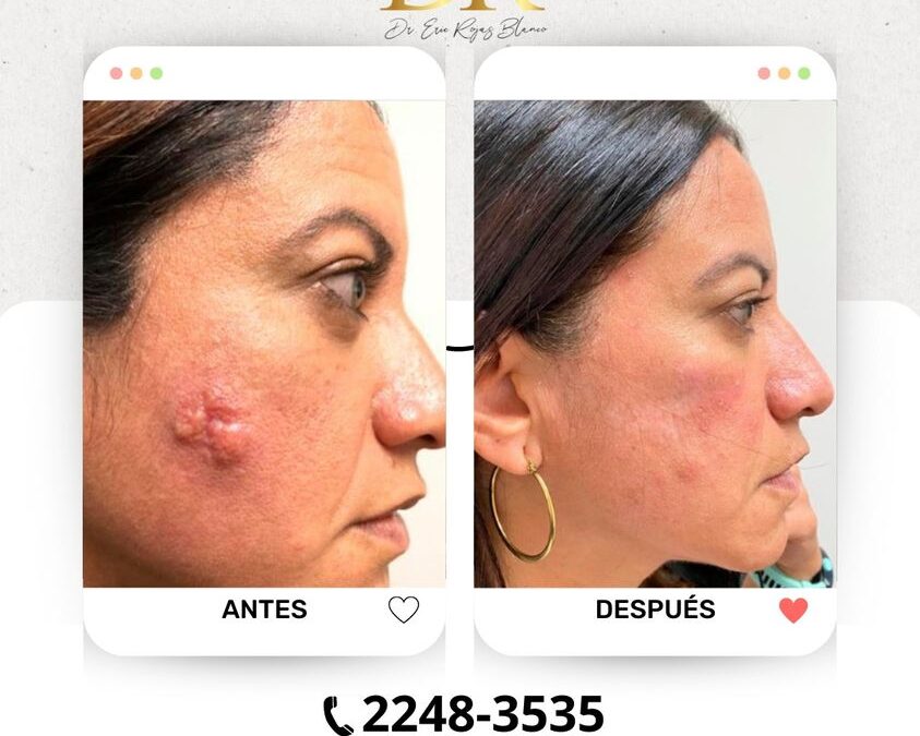 Eliminamos este Cáncer de Piel.