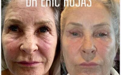 Rejuvenecimiento Facial, la mejor técnica del país.