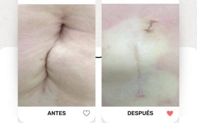 |Esa cicatriz que dejo tu cesárea o cirugía que divide tu abdomen ya