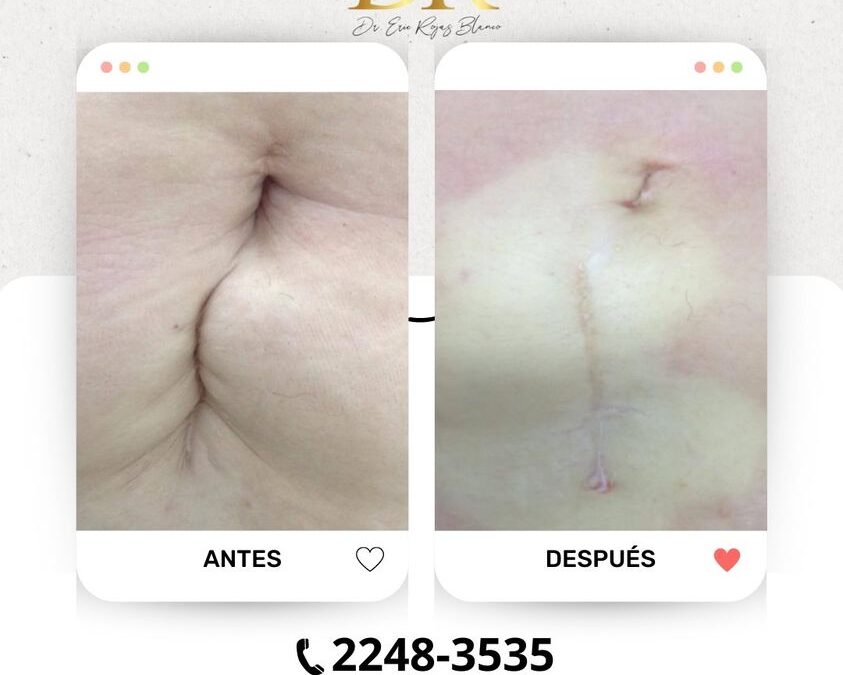 |Esa cicatriz que dejo tu cesárea o cirugía que divide tu abdomen ya