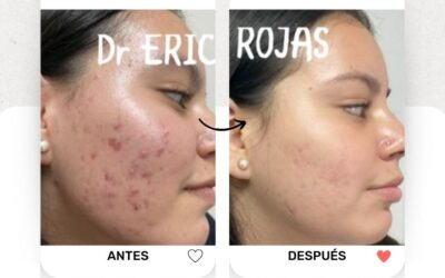 Elimina el acné y limpia tu rostro.