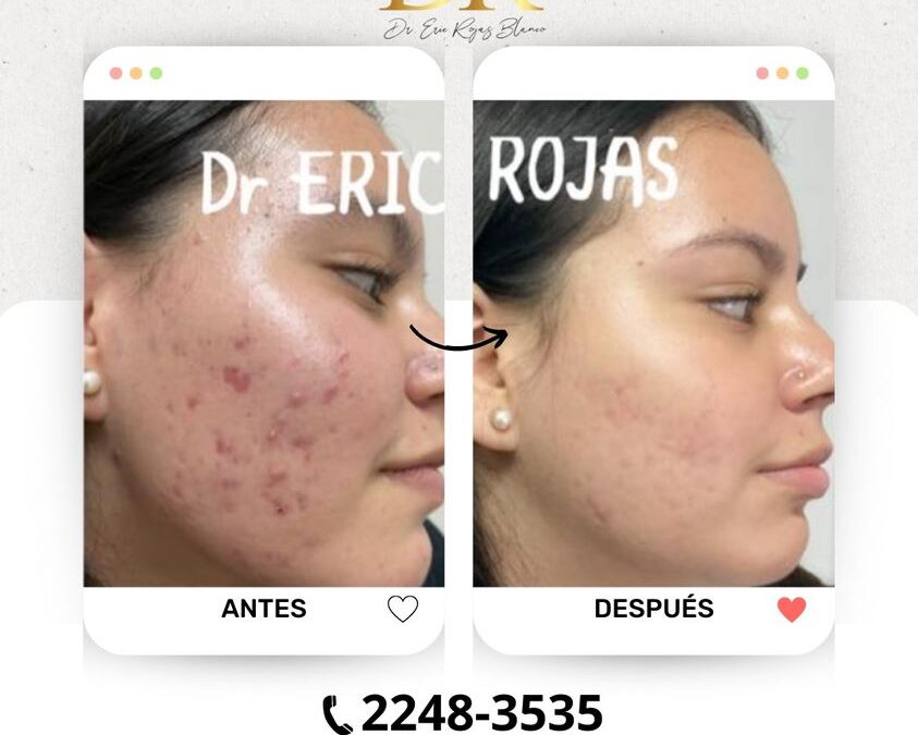 Elimina el acné y limpia tu rostro.