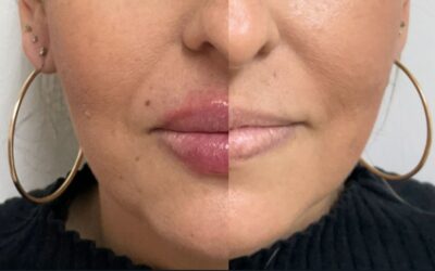 Mira el cambio de nuestra paciente, Relleno de labios en solo $399 USD