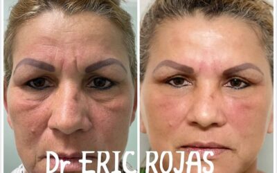 Refrescamiento FACIAL DR ERIC ROJAS 22483535