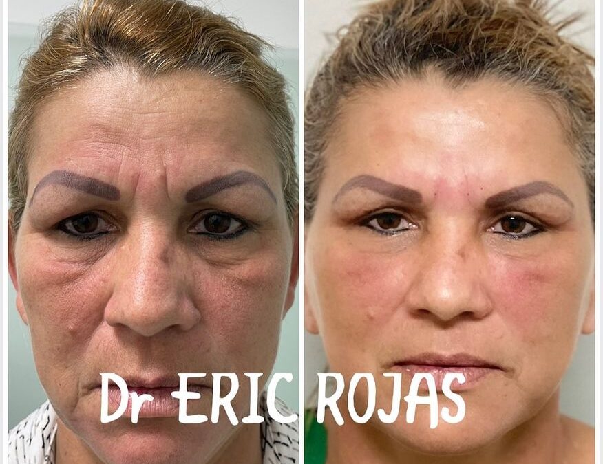 Refrescamiento FACIAL DR ERIC ROJAS 22483535