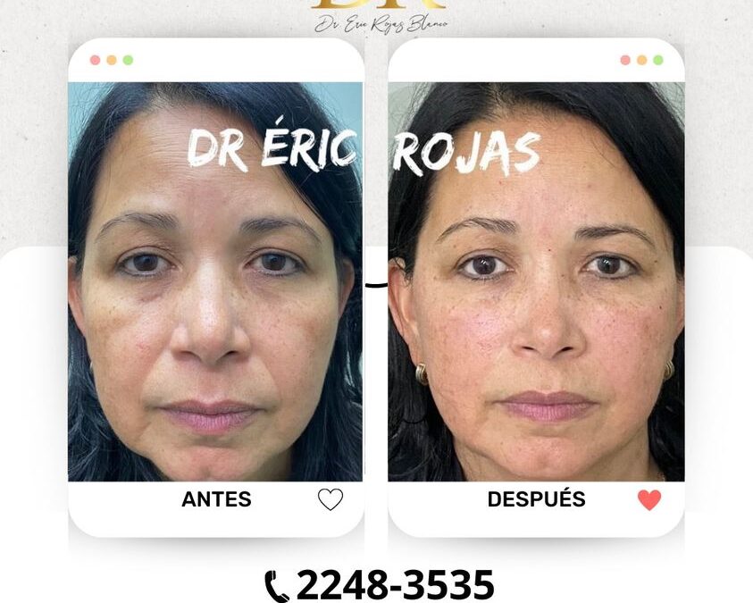Si necesitas rejuvenecer tu rostro, somos los indicados.