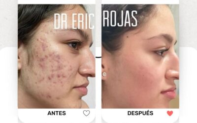 El acné es complejo de muchos, nosotros hacemos que sea diferente y solucionamos tu problema.