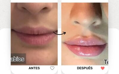 Relleno de labios en promoción $399 USD.