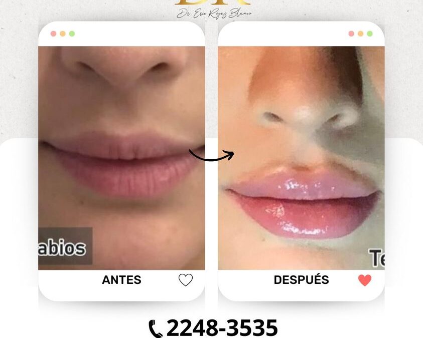 Relleno de labios en promoción $399 USD.