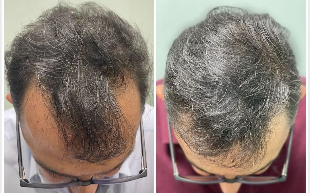 Trata tu alopecia, nosotros somos su solución.