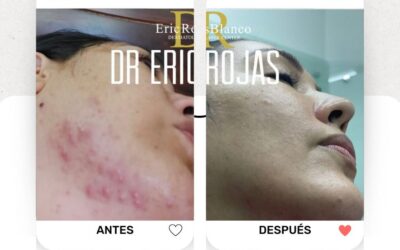 Soluciona tus problemas con el acné, nosotros hacemos realidad esto.  📲 Agenda tu cita virtual: +506 6179-3535