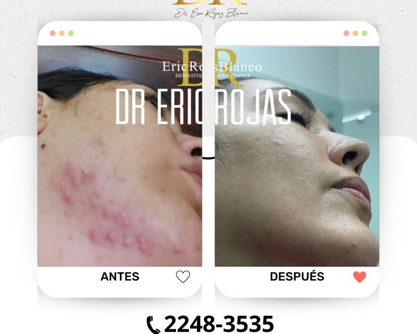 Soluciona tus problemas con el acné, nosotros hacemos realidad esto.  📲 Agenda tu cita virtual: +506 6179-3535