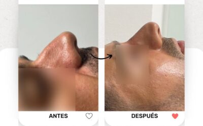 Rinolift, el procedimiento ideal para corregir tu nariz.